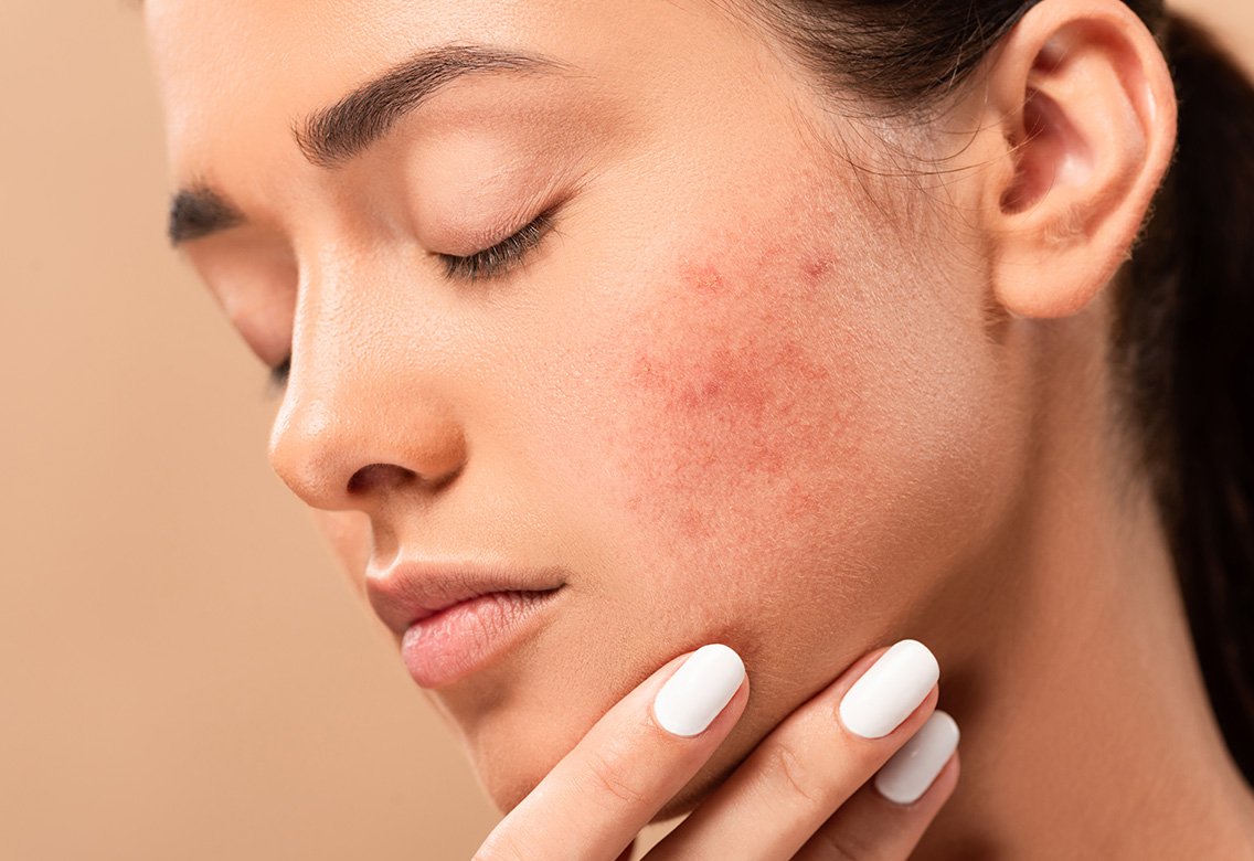 cuidado-facial-acne