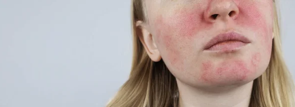 rosacea-piel