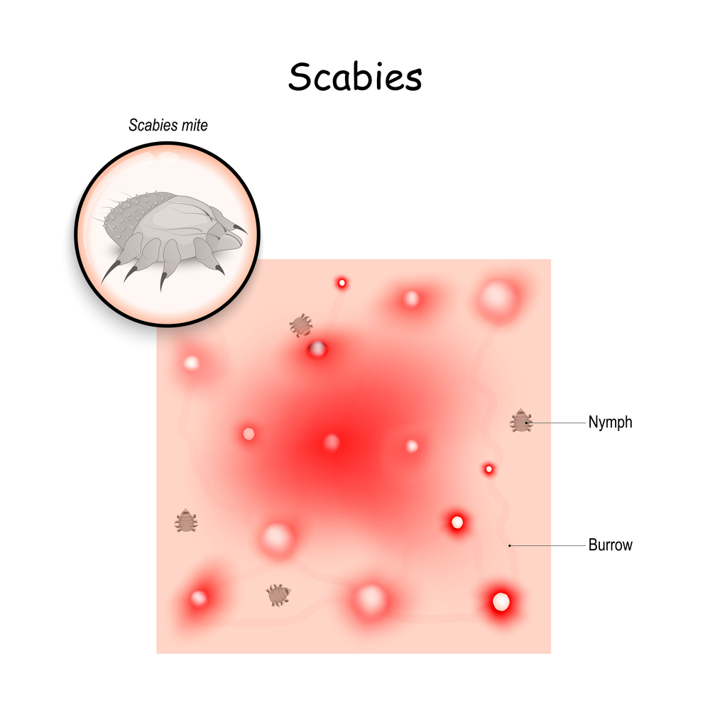 imagen grafica de tratamiento para escabiosis